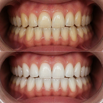 OFFICIAL ORAWRAP™ TRIAL RESULTS AFTER 10-DAYS.