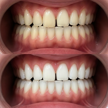 OFFICIAL ORAWRAP™ TRIAL RESULTS AFTER 10-DAYS.