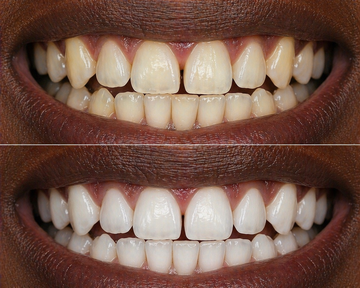 OFFICIAL ORAWRAP™ TRIAL RESULTS AFTER 10-DAYS.