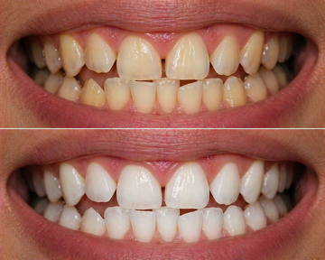 OFFICIAL ORAWRAP™ TRIAL RESULTS AFTER 10-DAYS.