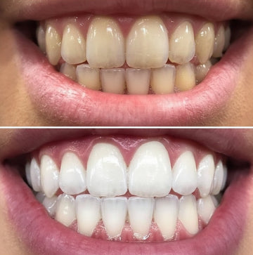 Toothfloof Orawraps - Before and after comparison of teeth whitening with a close-up of a mouth showing the difference.