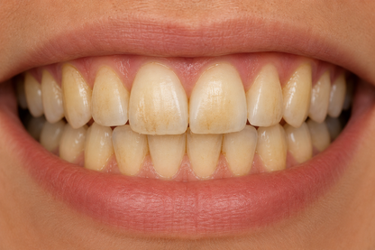 OraWrap | Pro-level Teeth Whitening Wraps