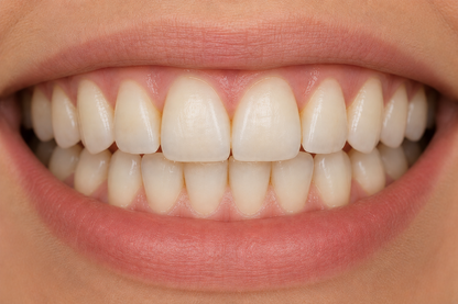 OraWrap | Pro-level Teeth Whitening Wraps